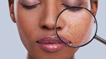 Mole Removal Treatment