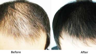Hair Loss Treatment