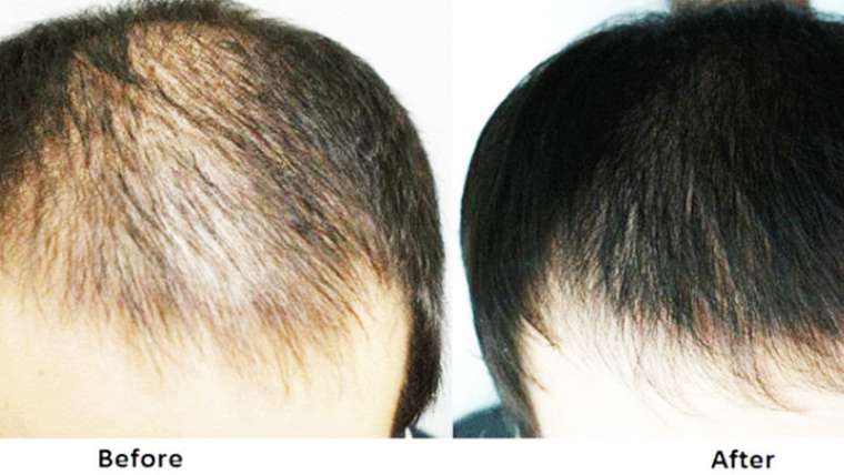 Hair Loss Treatment