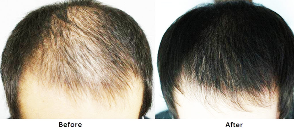 Hair Loss Treatment