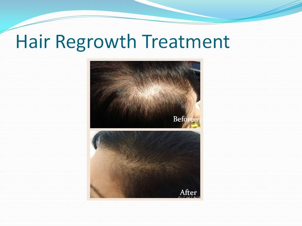Hair Regrowth