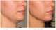 ultherapy before after lower face 7