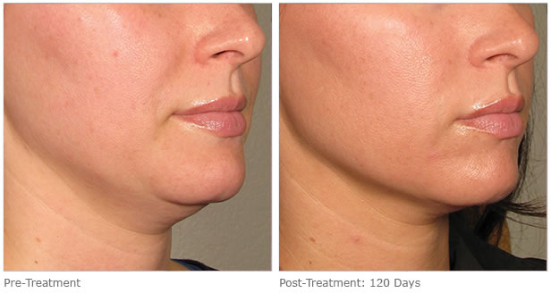 ultherapy before after lower face 7