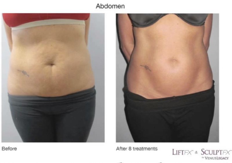 venus legacy before after photos 01