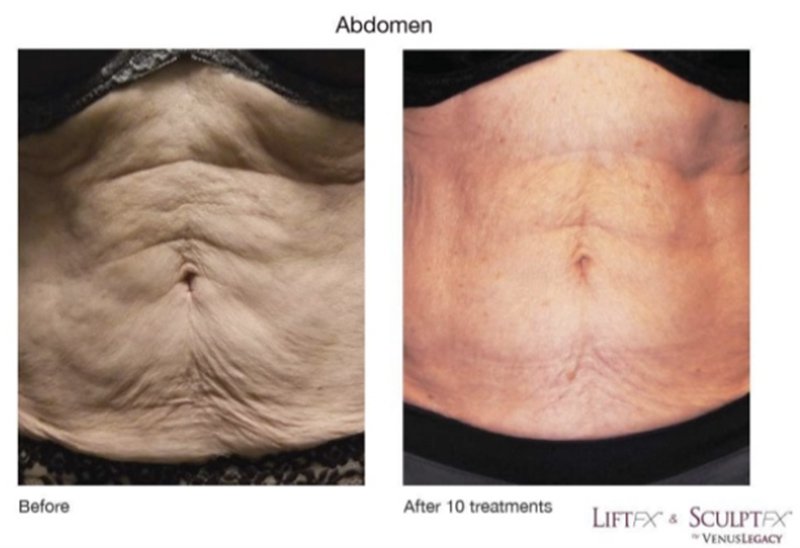 venus legacy before after photos 02